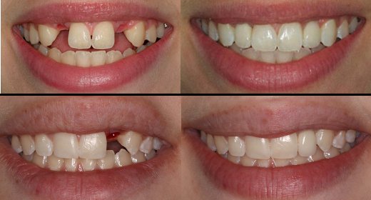 Implants-dentaires-avant-après