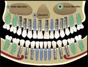 Caractéristiques implants dentaires