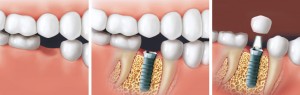 implants dentaires