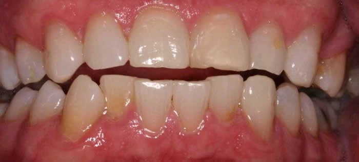 Dents jaunes : découvrez les différentes causes de cette coloration gênante